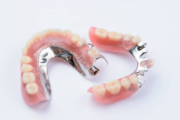 abnehmbare metall teilprothese auf weißem hintergrund - dentures stock-fotos und bilder