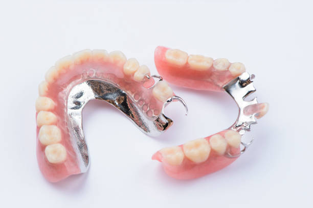 removable metal partial denture on white background - dentures imagens e fotografias de stock