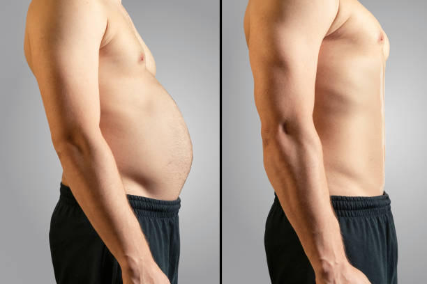 before and after losing fat - liposuction imagens e fotografias de stock