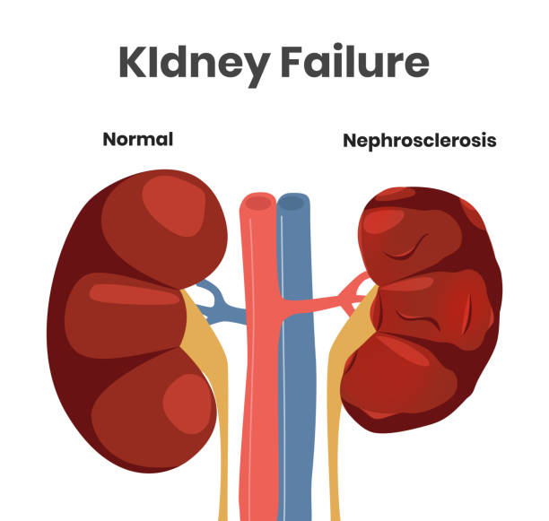 ilustrações de stock, clip art, desenhos animados e ícones de vector illustration of the kidney failure. normal kidney versus kidney affected with nephrosclerosis - doença crónica ilustrações