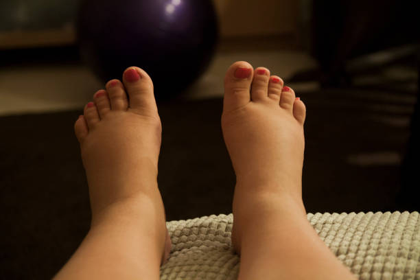 Swollen feet during pregnancy This is a photo of swollen feet during pregnancy swollen stock pictures, royalty-free photos & images