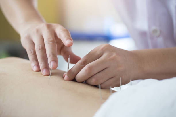 traditional chinese medicine treatment - acupuncture - acupuncturist imagens e fotografias de stock