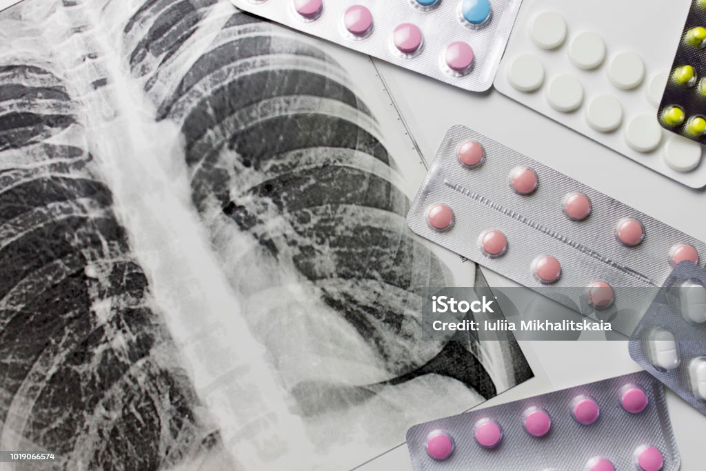 Fluorograpy, x-ray and different pills in blisters on white background. Fluorography, x-ray and different pills in blisters on white background Tuberculosis Bacterium Stock Photo