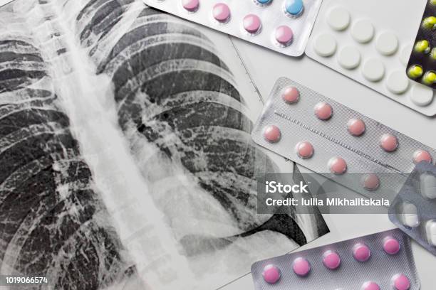 Fluorograpy Xray And Different Pills In Blisters On White Background Stock Photo - Download Image Now