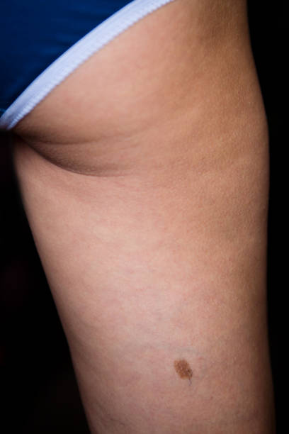 istock Birthmark on the female thigh from behind. 1019368752