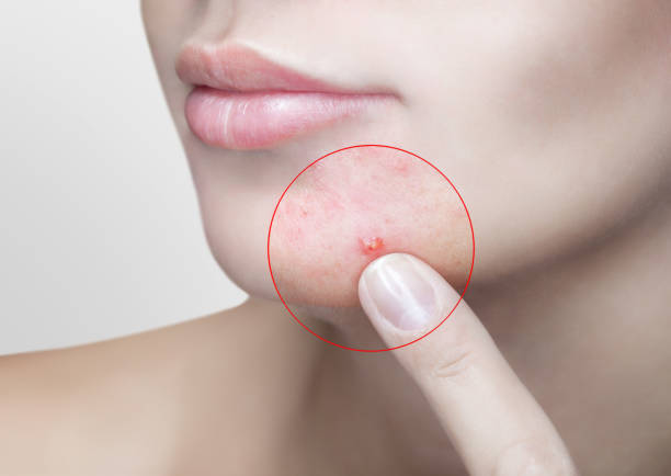 istock The girl shows problem skin. 1019379604