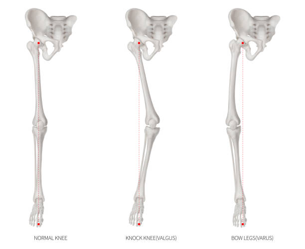 alignment types disease of lower half limbs or leg bone problem- normal- knock knee and bowlegs or valgus and varus knee- 3d medical illustration-human anatomy and educational concept white background - osteoarthritis doctor medicine healthcare and medicine imagens e fotografias de stock