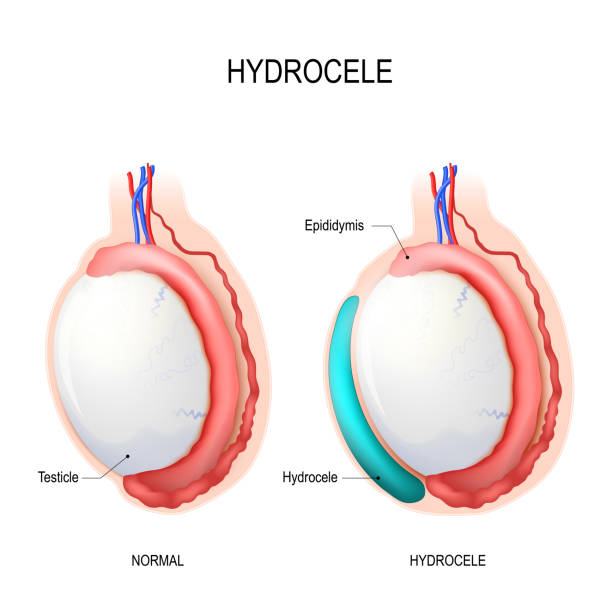 Hydrocele. Testicular disease. Hydrocele is an accumulation of serous fluid in a body cavity. Testicular disease. male reproductive system. Vector diagram for science and medical use male reproductive system cross section stock illustrations