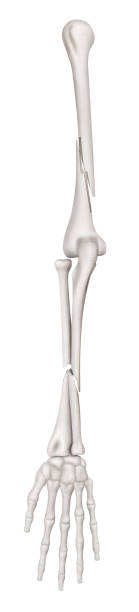 istock Ulna- Radius and Humerus Fractures or Broken Arms completed displaced fracture type anterior view- 3D Medical illustration- Healthcare- Human Anatomy and Medical Concept-Isolated white background. 1019890338