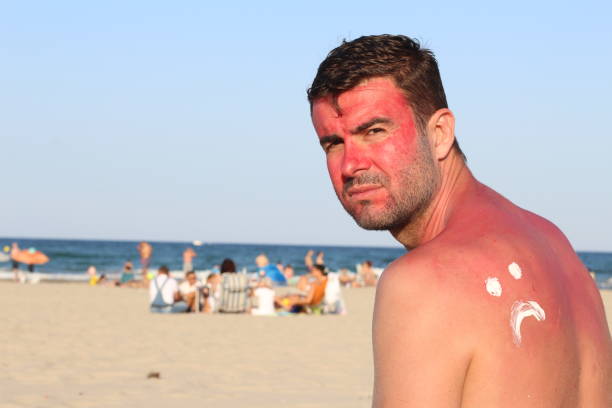 istock Man suffering the consequences of too much uv light exposure 1020083360