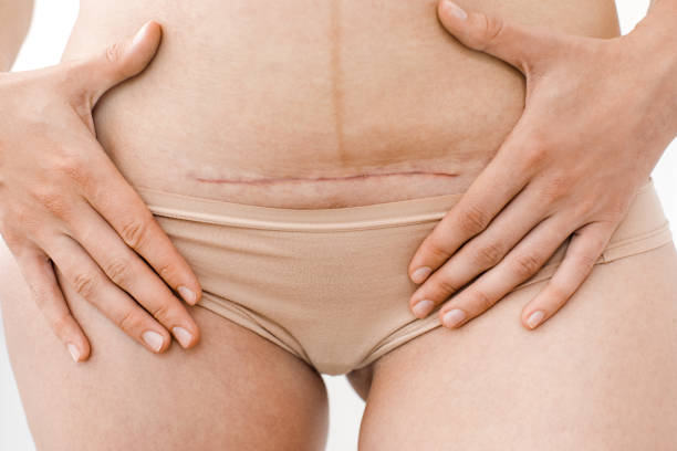 closeup of woman's belly with a scar from a cesarean section stock photo