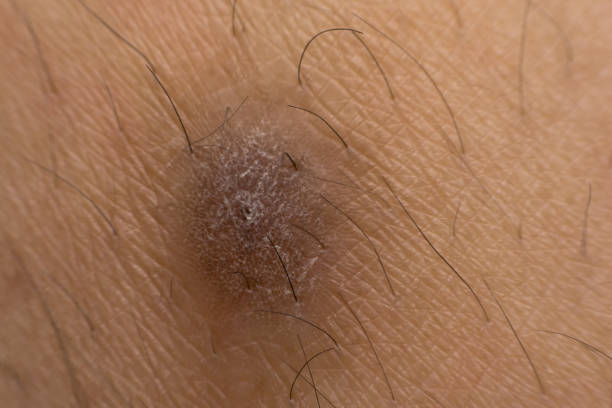 istock Close up Keloid scar (Hypertrophic Scar) on skin 1020703760