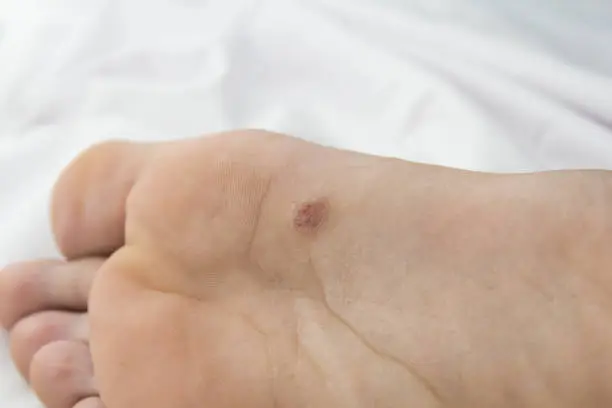 foot with problem areas on the skin.close up