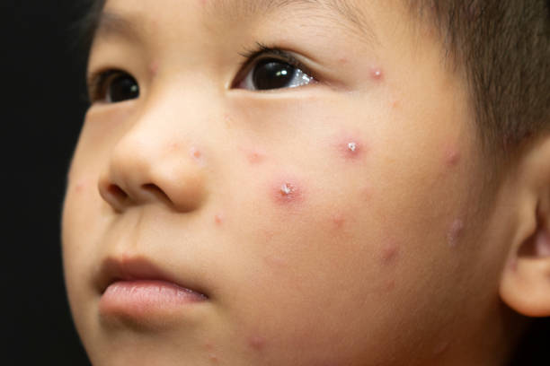 istock a male child with chickenpox 1021208304
