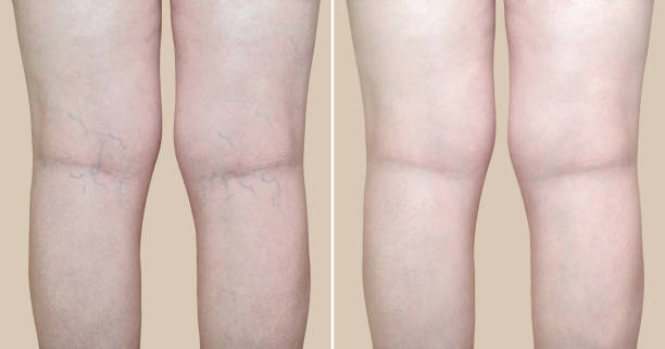 legs of a woman with varicose veins and capillaries before and after medical treatment - animal vein fotos imagens e fotografias de stock