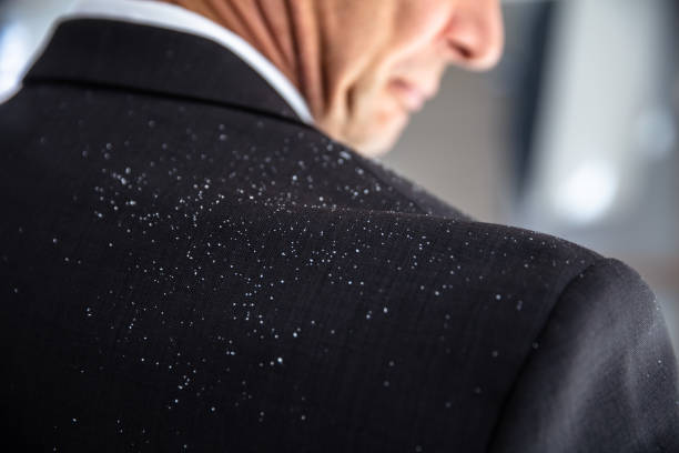 Dandruff Fallen On Businessperson's Shoulder Close-up Of A Businessperson With Dandruff On His Shoulder dandruff men stock pictures, royalty-free photos & images