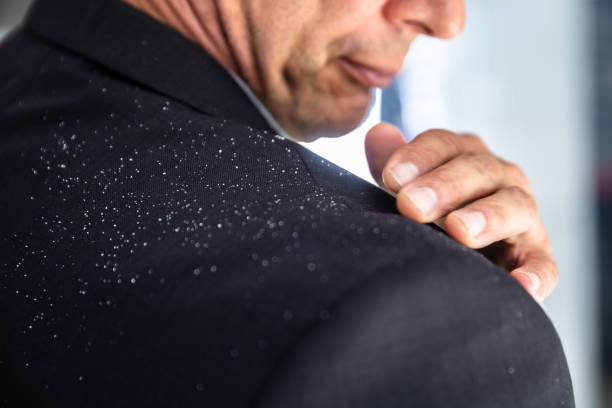 Businessman Brushing Off Fallen Dandruff On Shoulder Close-up Of A Businessman's Hand Brushing Off Fallen Dandruff On Shoulder dandruff stock pictures, royalty-free photos & images