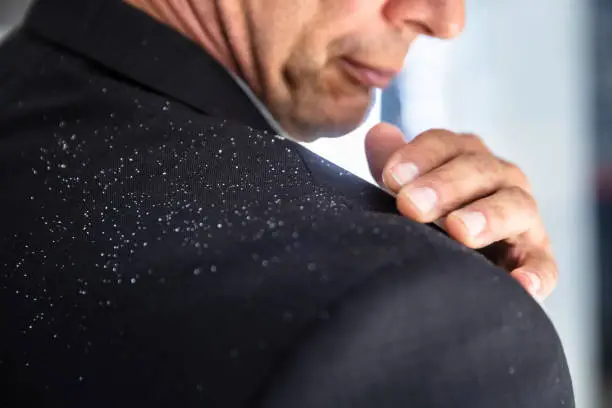 Close-up Of A Businessman's Hand Brushing Off Fallen Dandruff On Shoulder