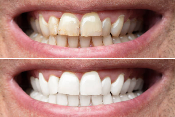istock Man Teeth Before And After Whitening 1021543344