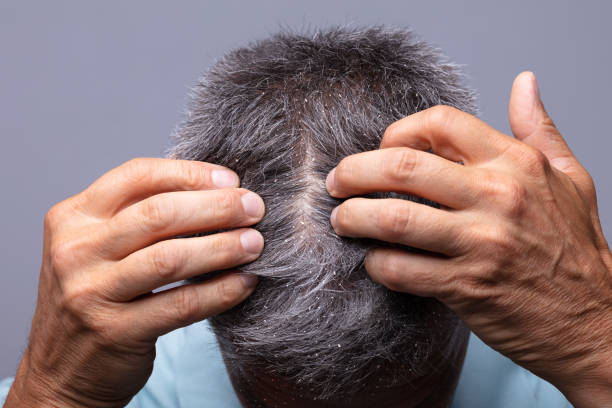Dandruff On Man's Hair Mature Man With Dandruff Scratching His Head dandruff men stock pictures, royalty-free photos & images
