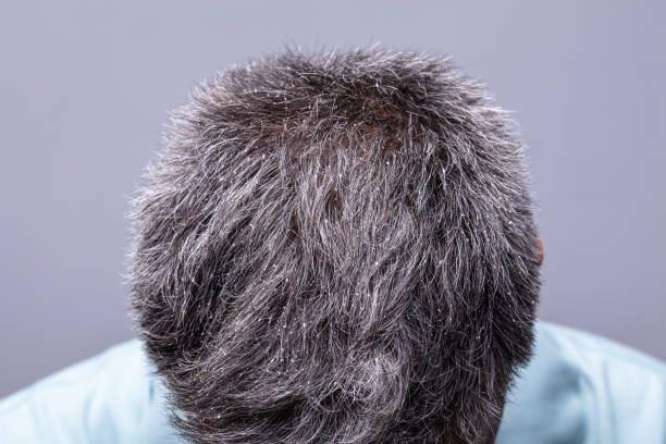 istock Dandruff On Man's Hair 1021543392