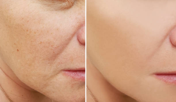 istock wrinkles face woman before and after procedures 1022167232