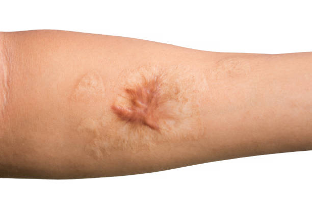 Close up Keloid scar (Hypertrophic Scar) on man arm skin after accident isolated on white background. Close up Keloid scar (Hypertrophic Scar) on man arm skin after accident isolated on white background. scar stock pictures, royalty-free photos & images