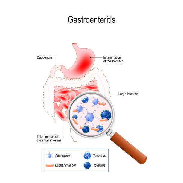 Gastroenteritis Gastroenteritis is an infectious diarrhea, inflammation of the gastrointestinal tract (stomach, and small intestine). caused by viruses (rotavirus, adenovirus, norovirus) and bacteria Escherichia coli. Vector illustration for your design, educational, biology, scientific, and medical use. gastroenteritis stock illustrations