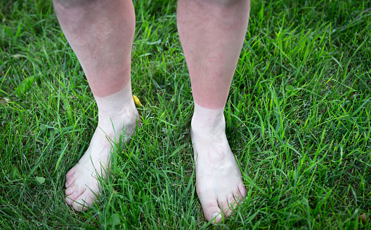 horizontal image of a pair of  caucasian male  legs  sun burned down to the ankles  up to the bare feet while standing in green grass.