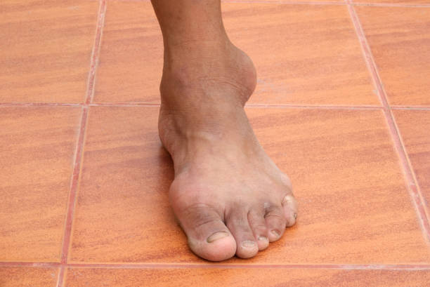 통풍 - bunion bunions human foot podiatry 뉴스 사진 이미지