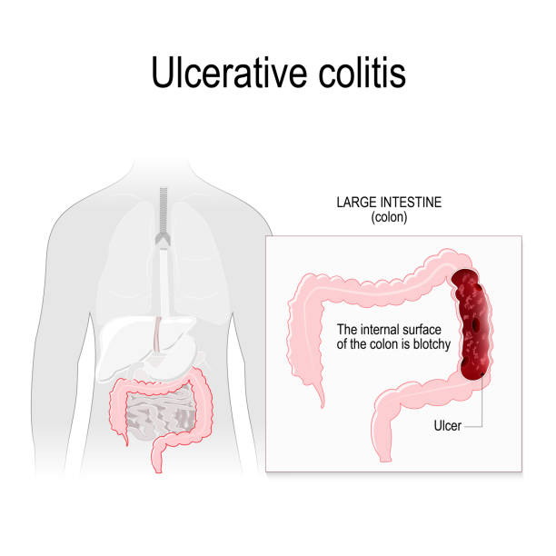 Ulcerative colitis Ulcerative colitis is inflammation and ulcers of the colon and rectum. anatomical locations the colon. Human silhouette with highlighted internal organs. Close-up of the internal surface of the colon. Vector illustration for biology, scientific, and medical use. colon cancer screening stock illustrations