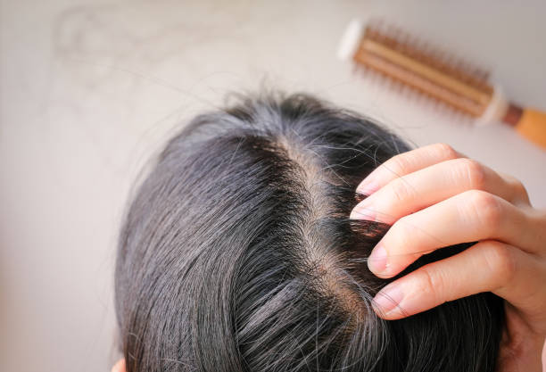 istock hair fall and lost alopecia woman problem on the comb. 1023831860