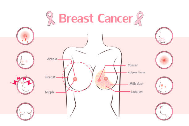illustrations, cliparts, dessins animés et icônes de femme avec symptôme de cancer du sein - lactiferous duct