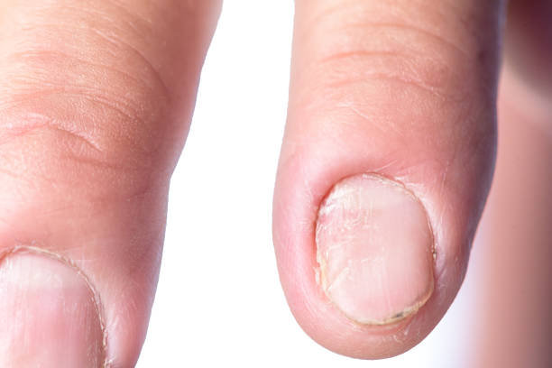 Psoriasis In Toenails Stock Photos, Pictures & Royalty-Free Images - iStock