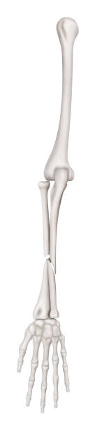 istock Ulna and Radius Fractures or Broken Arms completed displaced fracture type anterior view-3D Medical and Biomedical illustration- Healthcare- Human Anatomy and Medical Concept-Isolated white background 1024248250