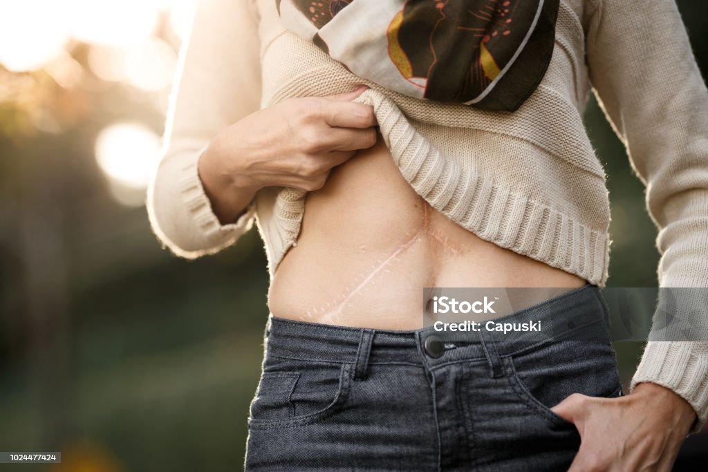 Girl showing her liver transplant scars Close of belly of a girl with liver transplant scars. Scar Stock Photo
