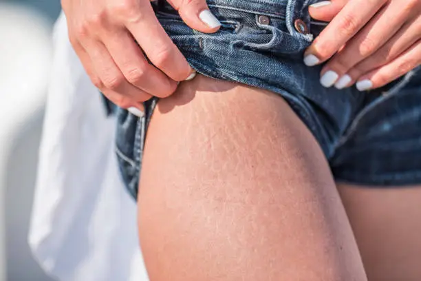 Stretch marks on a caucasian woman's leg.