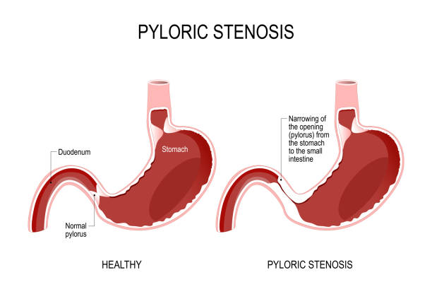 illustrazioni stock, clip art, cartoni animati e icone di tendenza di stenosi pilorica - piloro