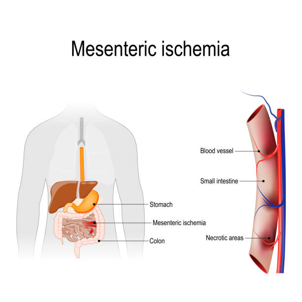 Mesenteric ischemia Mesenteric ischemia is an injury to the small intestine occurs due to not enough blood supply. Human silhouette with internal organs. Vector illustration for biology, scientific, and medical use. gangrene stock illustrations