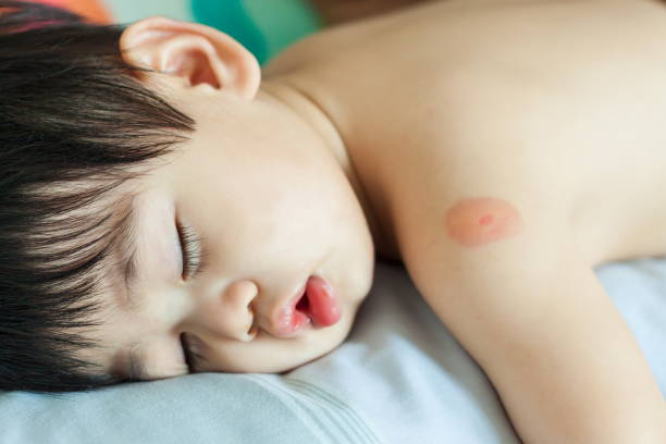 istock Baby sleep and Mosquito bites on arm. 1025076350