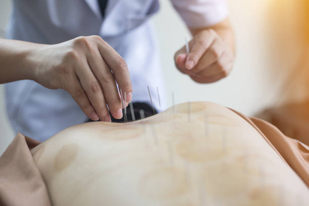 istock Traditional Chinese Medicine Treatment - Acupuncture 1025332964