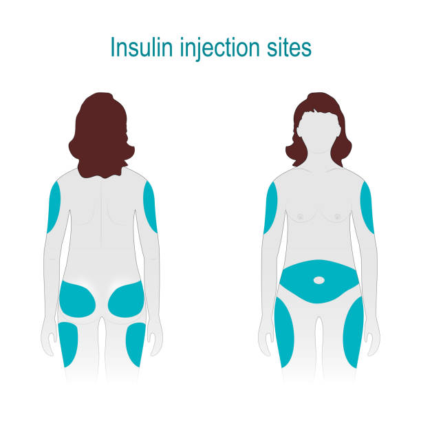 Insulin injection sites Insulin injection sites. Diabetes mellitus. Female body front and back view with Areas for Injection. Vector illustration for biology, scientific, and medical use. glycogen stock illustrations