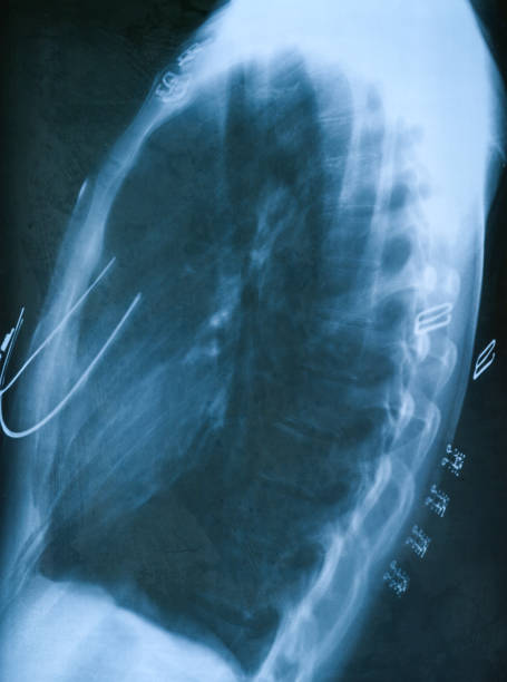 Thoracic cavity side X-ray Film