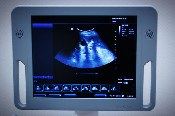The stone in the kidney