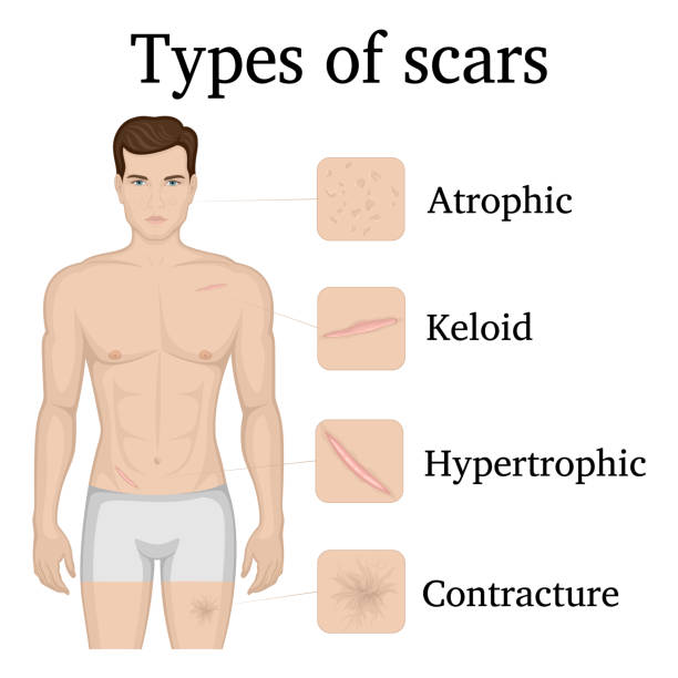 Illustration of the types of scars Illustration of four types of scars on the body of a man scar stock illustrations