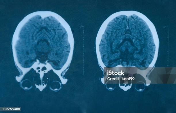 Mri Scan Human Head Flim Stock Photo - Download Image Now - MRI Scan, X-ray Image, Eye
