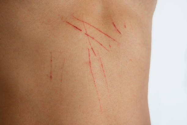 cat scratches on the skin. skin wounds - animal skin fotos imagens e fotografias de stock