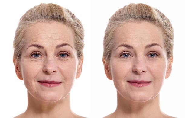 женщина среднего возраста сталкивается до и после косметической процедуры. концепция пластической хирургии. - wrinkle treatment стоковые фото и изображения
