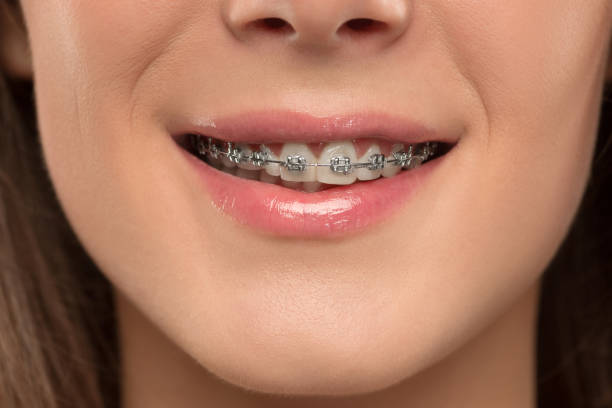 istock Beautiful young woman with teeth braces 1026515072