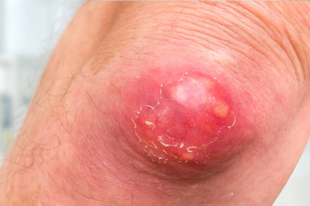 istock Detailed view of elbow with carbuncle or furuncle 1026563462